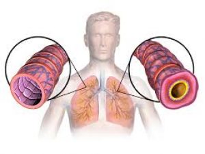 How To Stop Asthma From Ruining Your Social Life